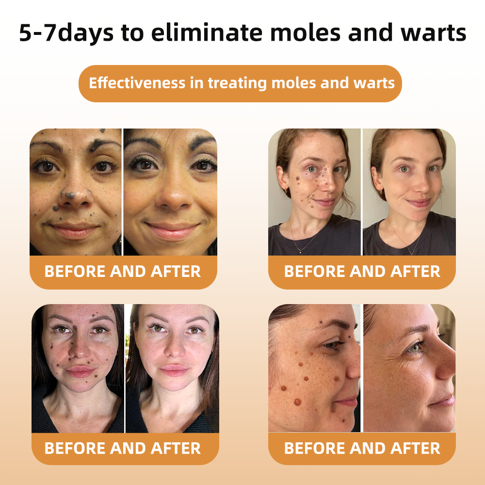 💎WREE™ Bee Venom Wart & Tag Removal Cream(👨⚕Suitable for all skin types)🐝(🔥Last day promotion 60% off)
