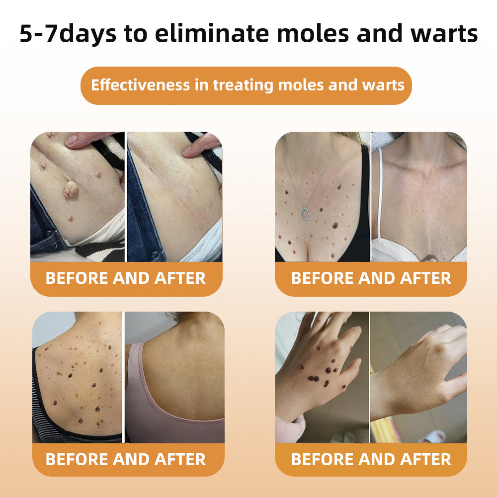 💎WREE™ Bee Venom Wart & Tag Removal Cream(👨⚕Suitable for all skin types)🐝(🔥Last day promotion 60% off)