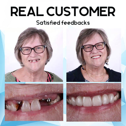 🦷🍃Bearnica™ 𝐒𝐢𝐥𝐢𝐜𝐨𝐧𝐞 𝐑𝐞𝐥𝐢𝐧𝐞 𝐃𝐞𝐧𝐭𝐮𝐫𝐞 𝐒𝐞𝐭 (⏰𝐋𝐢𝐦𝐢𝐭𝐞𝐝 𝐭𝐢𝐦𝐞 𝐝𝐢𝐬𝐜𝐨𝐮𝐧𝐭 𝐋𝐚𝐬𝐭 𝟑𝟎 𝐦𝐢𝐧𝐮𝐭𝐞𝐬⏰)